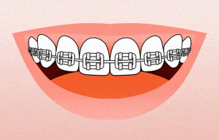 brushing with braces